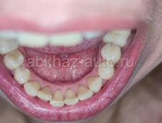 Ультразвуковая чистка зубов 