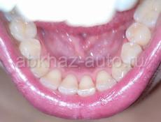 Ультразвуковая чистка зубов 