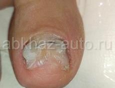 Проблемные ногти, лечение проблемных ногтей