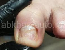 Проблемные ногти, лечение проблемных ногтей