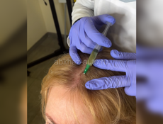 Ищу модель для мезотерапии кожи головы 💉