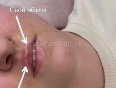 Увеличение губ/инъекционная косметология