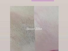 Лазерная эпиляция 