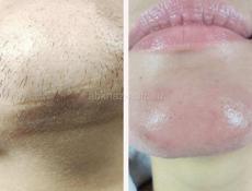 Электроэпиляция опыт 20 лет