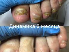 Медицинский педикюр. подолог